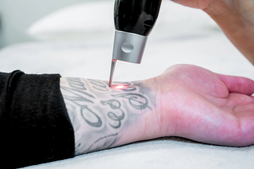 Laser Tattoo Removal