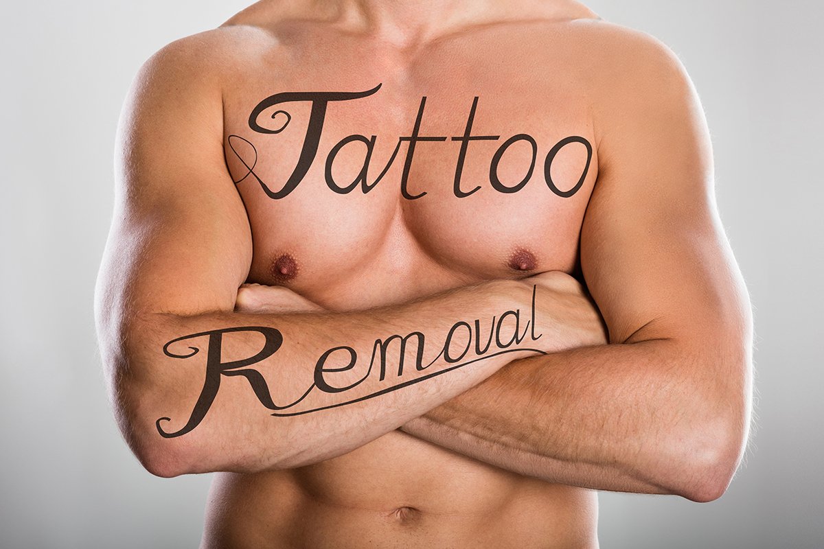 Tattoo Removal Men