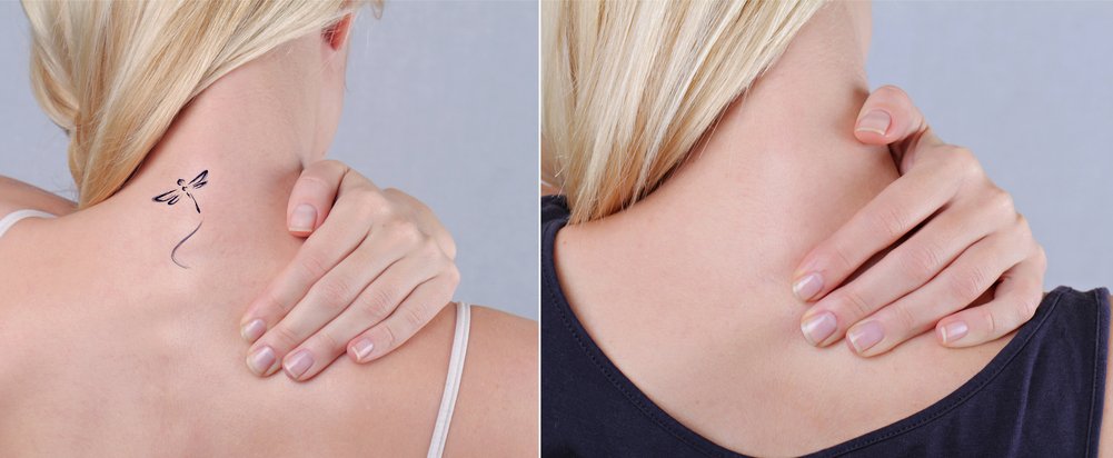 woman-neck-before-after